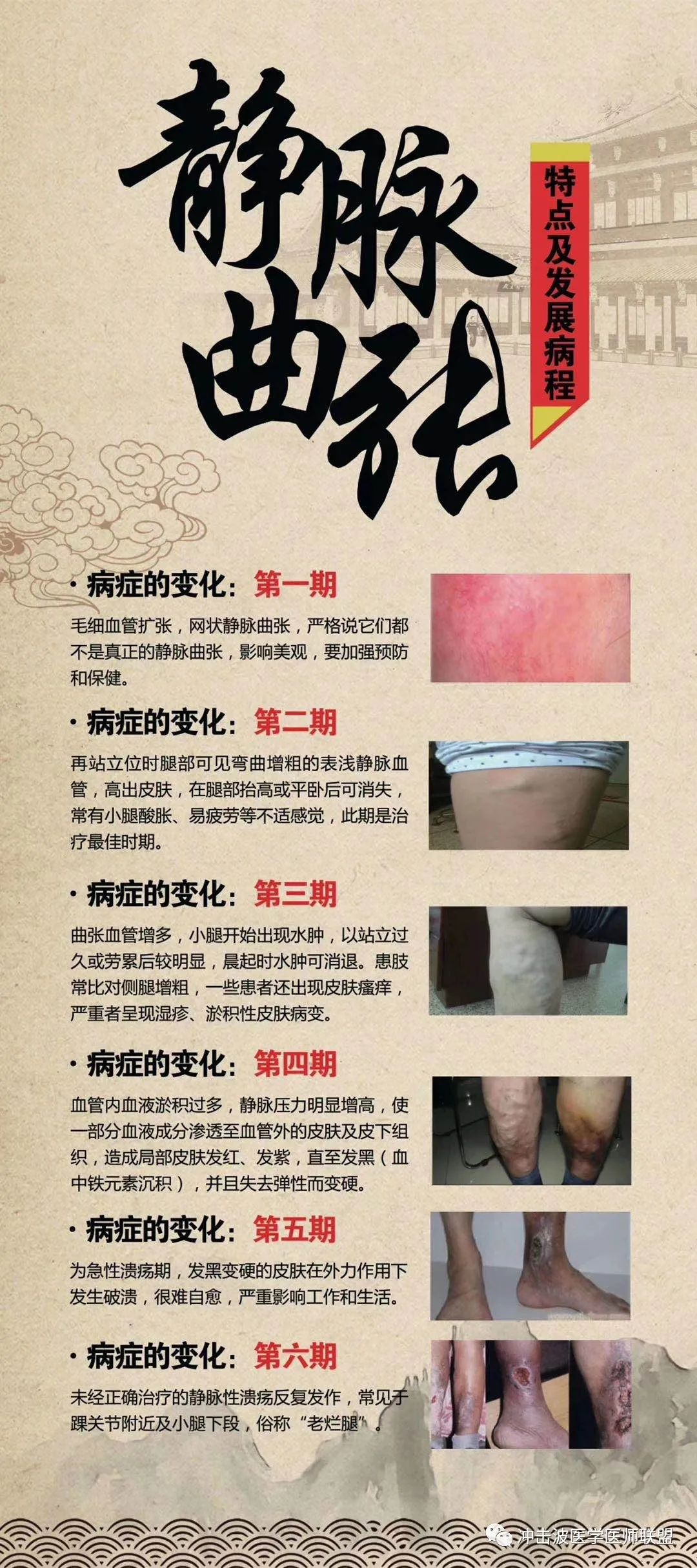 靜脈曲張新療法觀點論述與解析