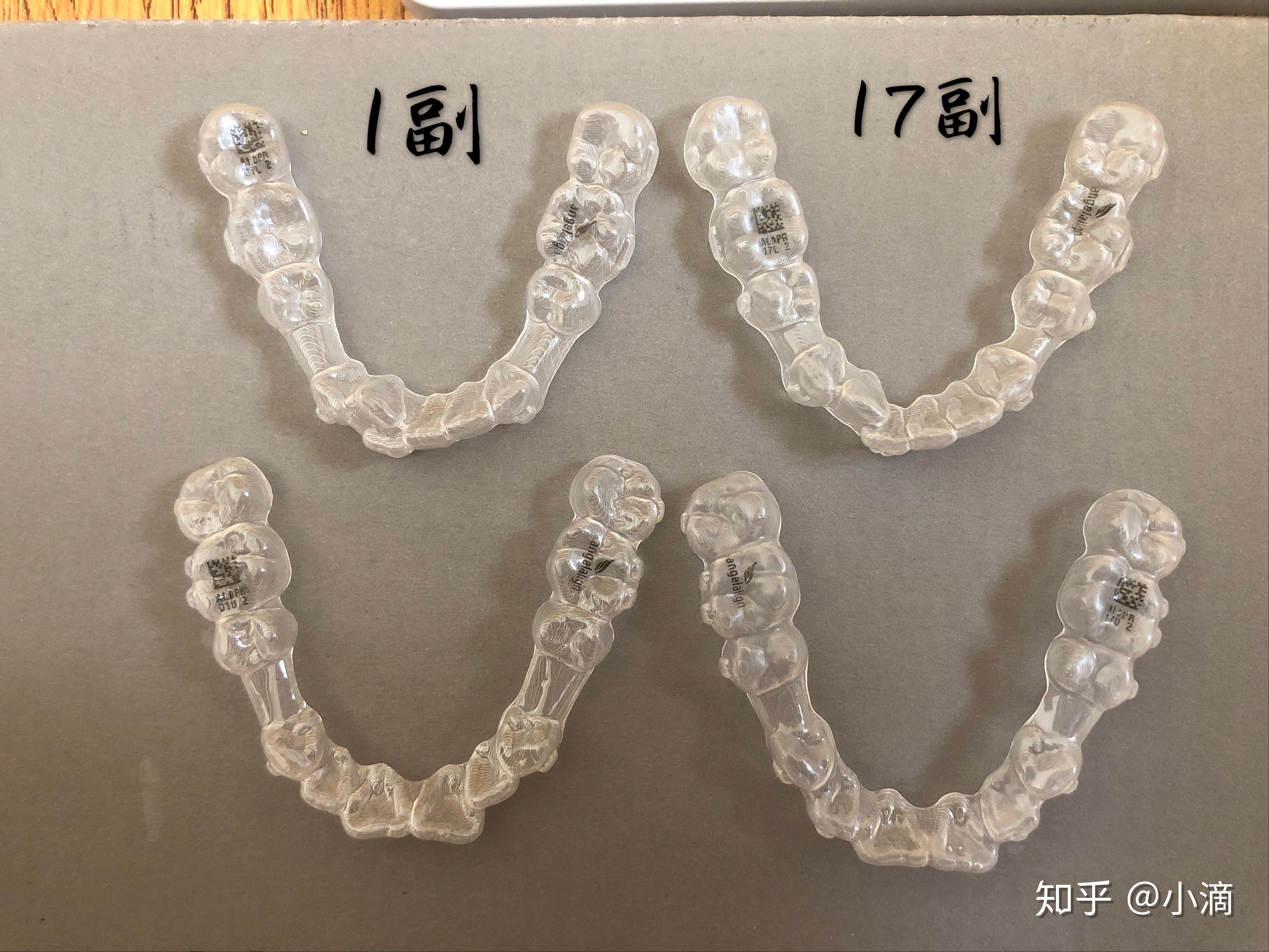 時代天使牙套價格揭秘，小巷中的美麗蛻變之旅啟動！