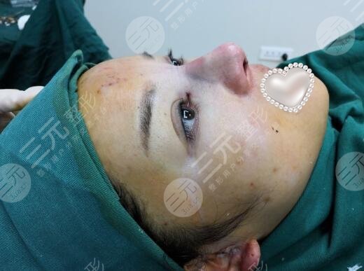 最新隆鼻手術(shù)，重塑鼻型，找回自信