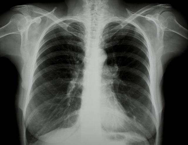涪陵最新肺炎疫情動(dòng)態(tài)更新??